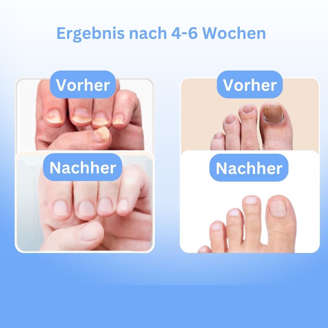 MykoCare Lichttherapie – Pijnloze Behandeling tegen Nagelschimmel zonder Chemie
