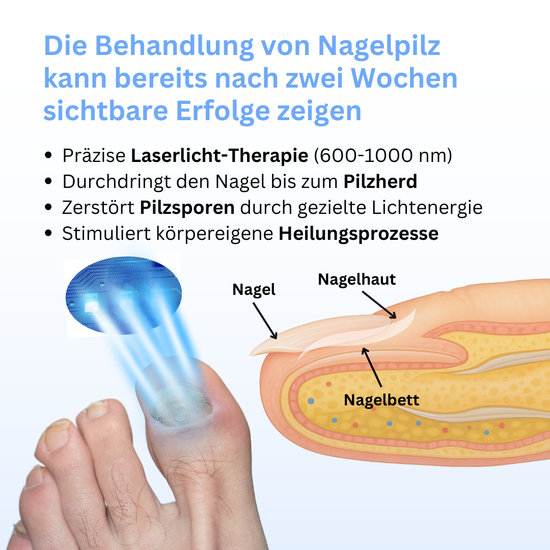 MykoCare Lichttherapie – Pijnloze Behandeling tegen Nagelschimmel zonder Chemie