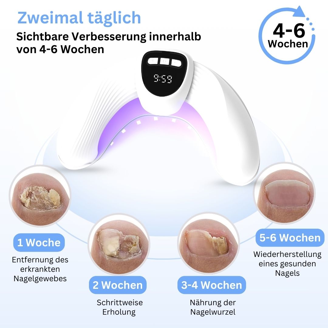 MykoCare Lichttherapie – Pijnloze Behandeling tegen Nagelschimmel zonder Chemie